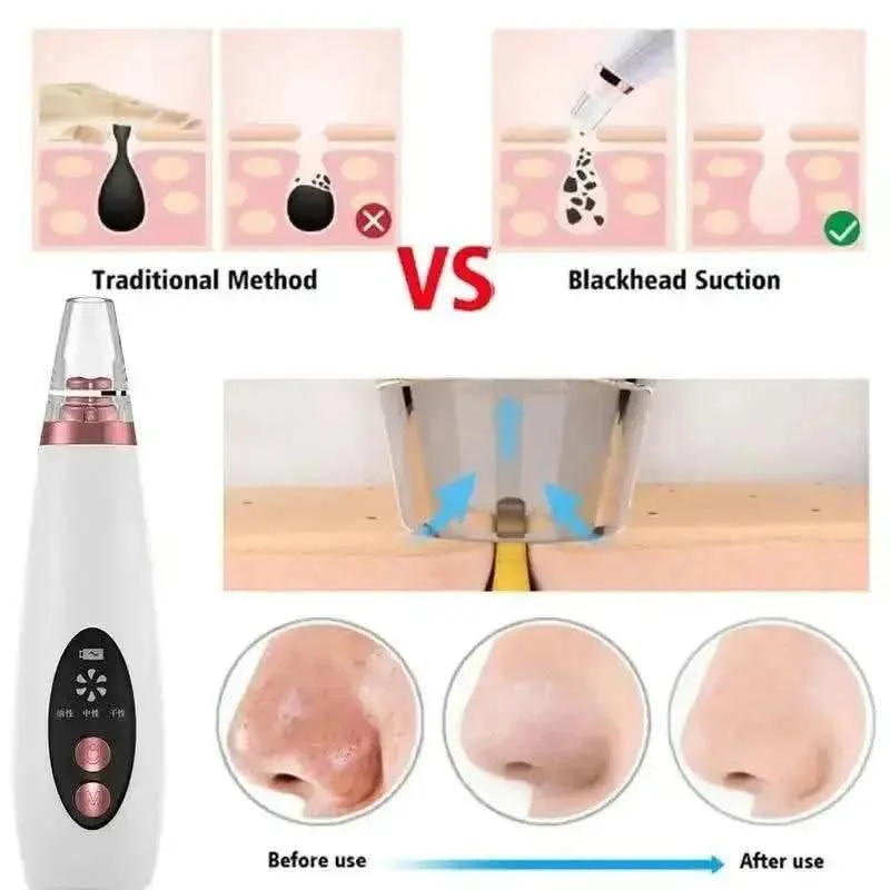 Electric Blackhead Remover Machine – Pore Vacuum Cleaner image 6